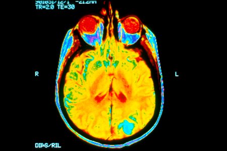 Brain MRI photo