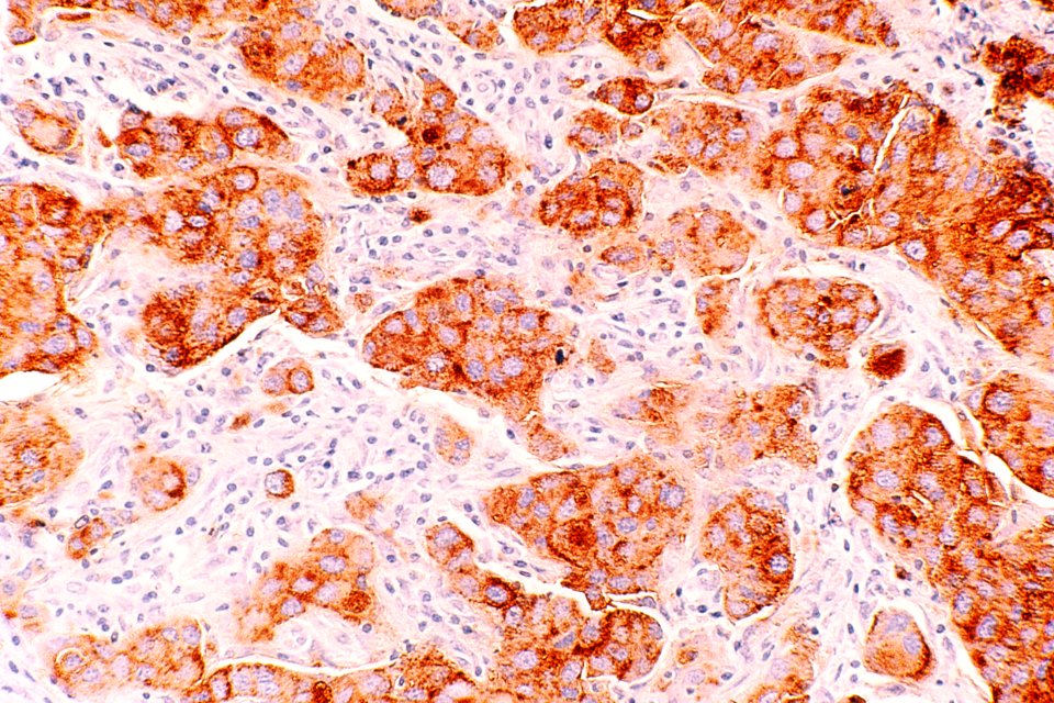 Breast cancer (ductal carcinoma) (1)
