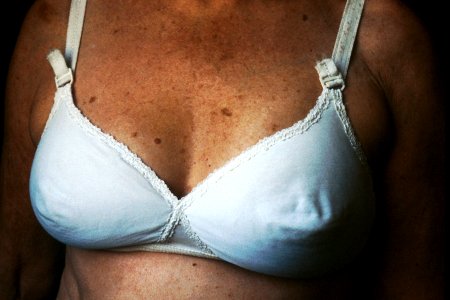 Breast reconstruction (4) photo