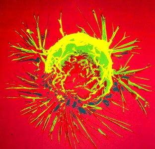 Breast Cancer and Alcohol Consumption (5881108114)