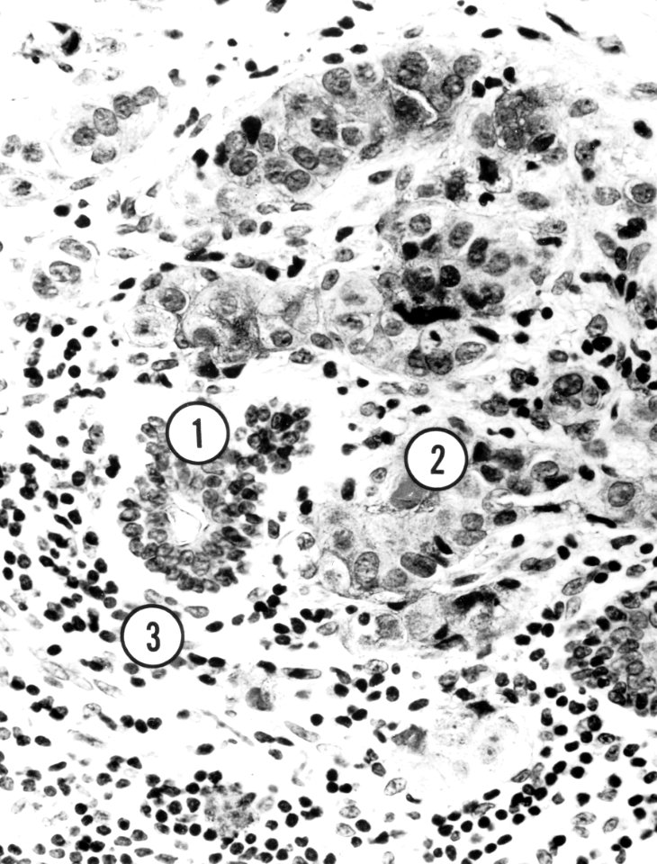 Breast cancer (ductal carcinoma)