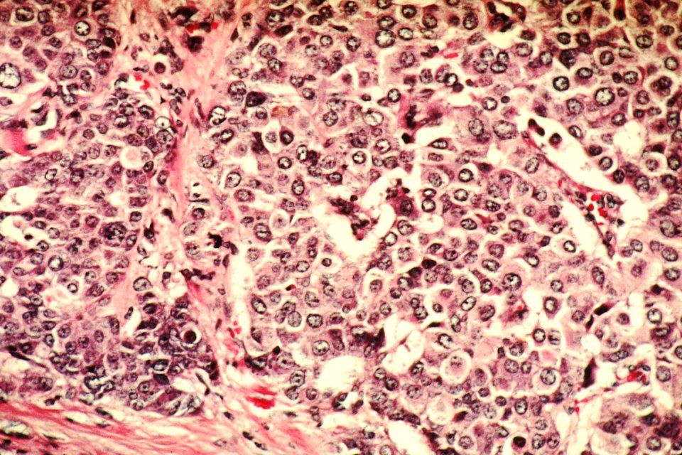 Breast cancer cells (1) photo