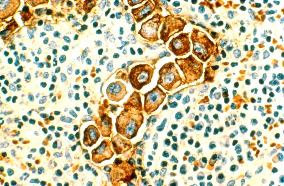 Breast cancer in the lymph nodes