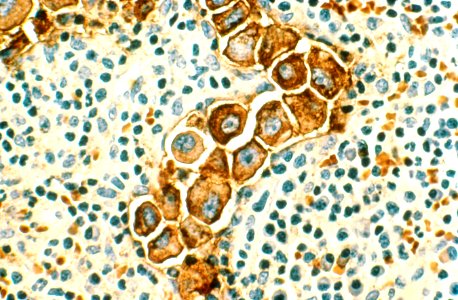 Breast cancer in the lymph nodes