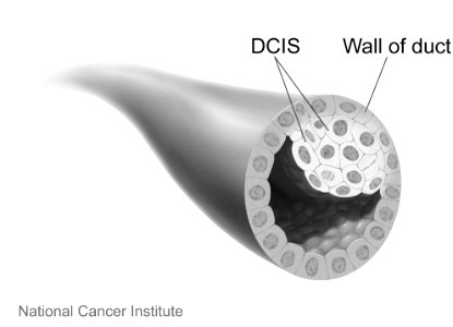 Breast cancer ductal carcinoma in situ