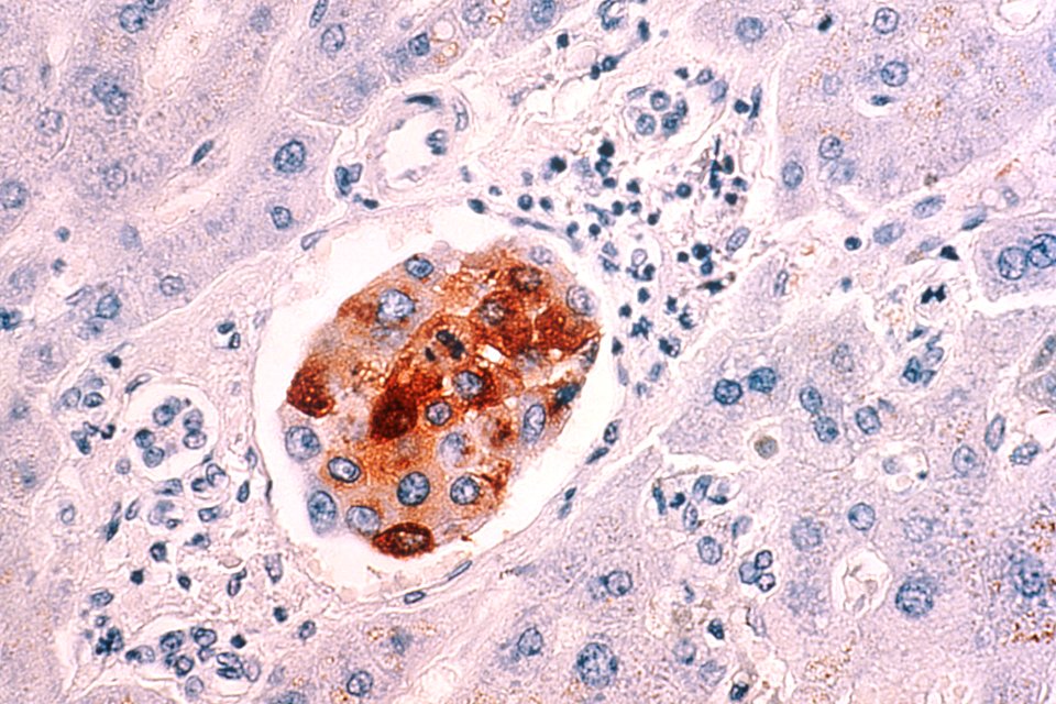 Breast cancer metastasis to liver