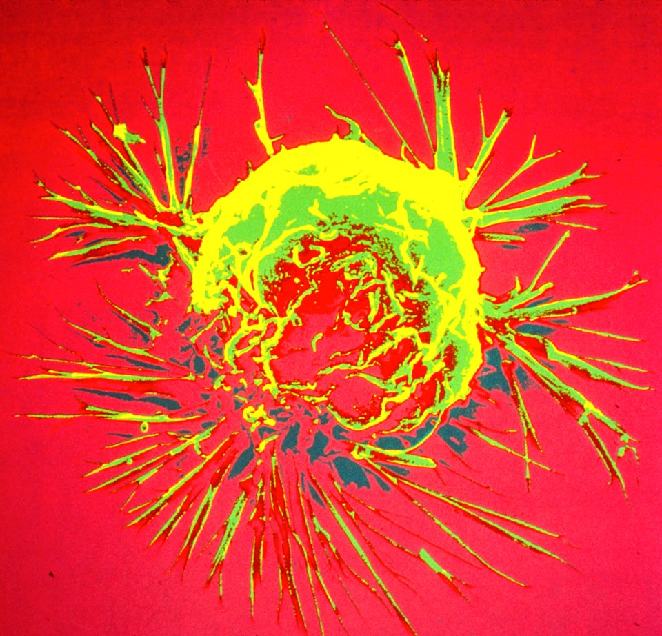 Breast cancer cell (1)