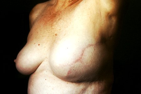 Breast reconstruction (2) photo