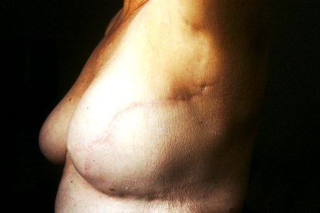 Breast reconstruction (1) photo