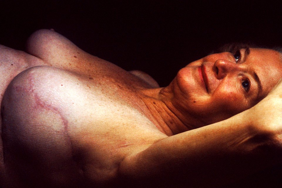 Breast reconstruction 2