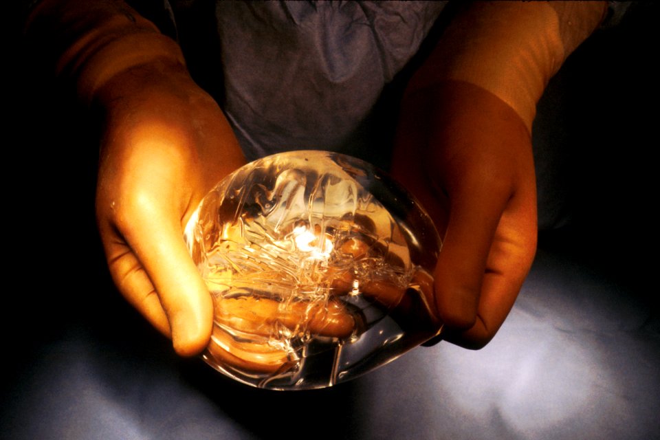 Breast surgery reconstruction