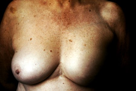Breast reconstruction (3) photo