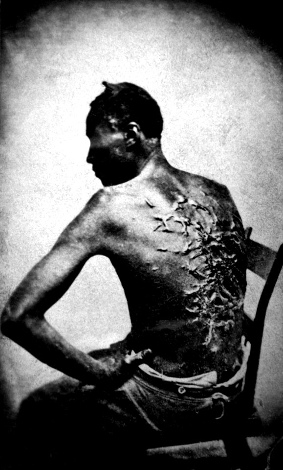 Cicatrices de flagellation sur un esclave