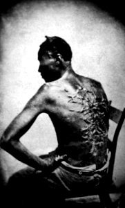 Cicatrices de flagellation sur un esclave