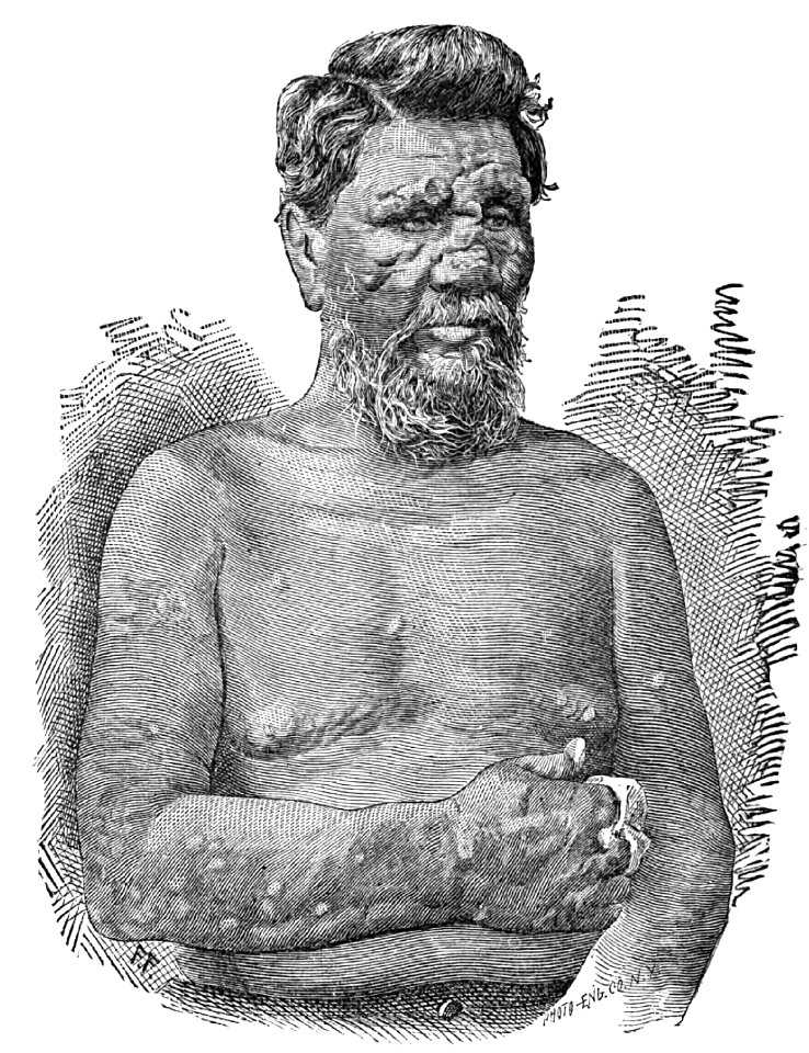 William Charles Keeaumoku Crowningburg. CASE XIV. (Photograph 12)