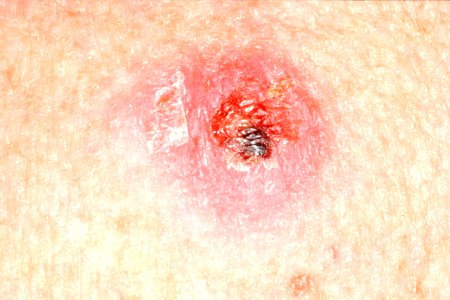 Crusty skin lump