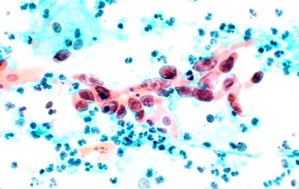 Cytological specimen showing cervical cancer