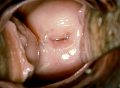 Diethylstilbestrol (des) cervix (1) photo
