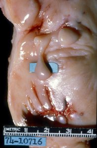 Diethylstilbestrol (des) cervix (13)