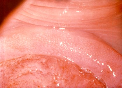 Diethylstilbestrol (des) cervix (17)