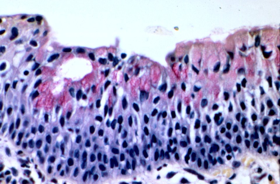 Diethylstilbestrol (des) cervix (20)