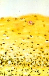 Diethylstilbestrol (des) cervix (24)