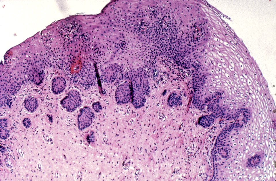 Diethylstilbestrol (des) cervix (28)