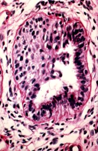Diethylstilbestrol (des) cervix (31)
