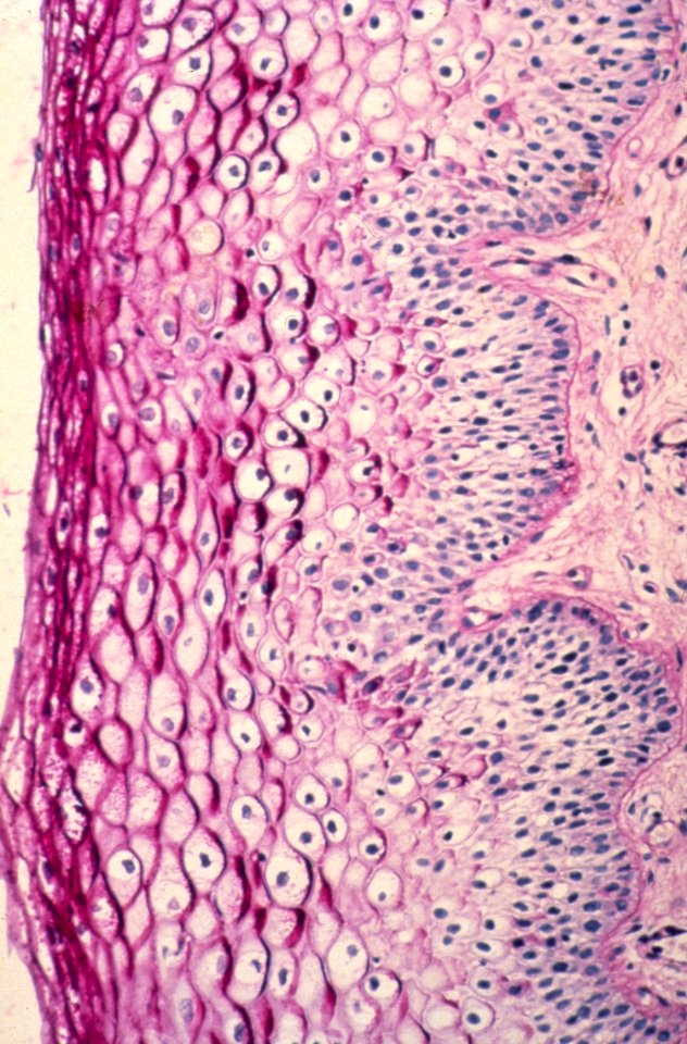 Diethylstilbestrol (des) cervix (35)