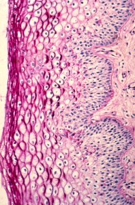 Diethylstilbestrol (des) cervix (35)