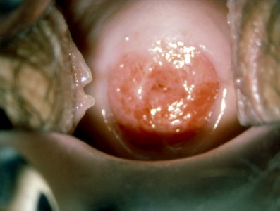 Diethylstilbestrol (des) cervix (10) photo