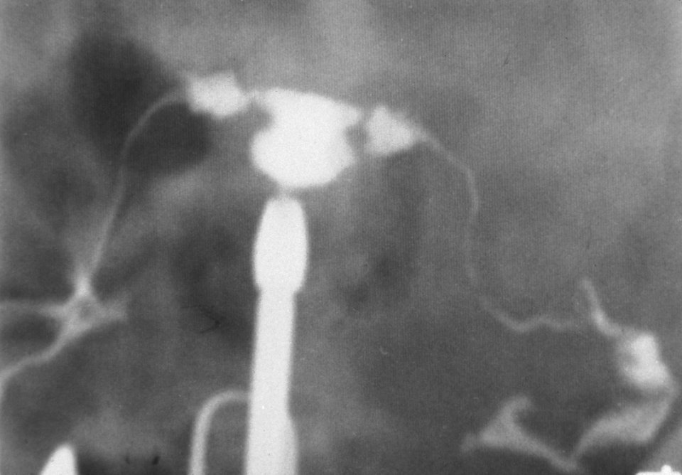 Diethylstilbestrol (des) cervix (42)