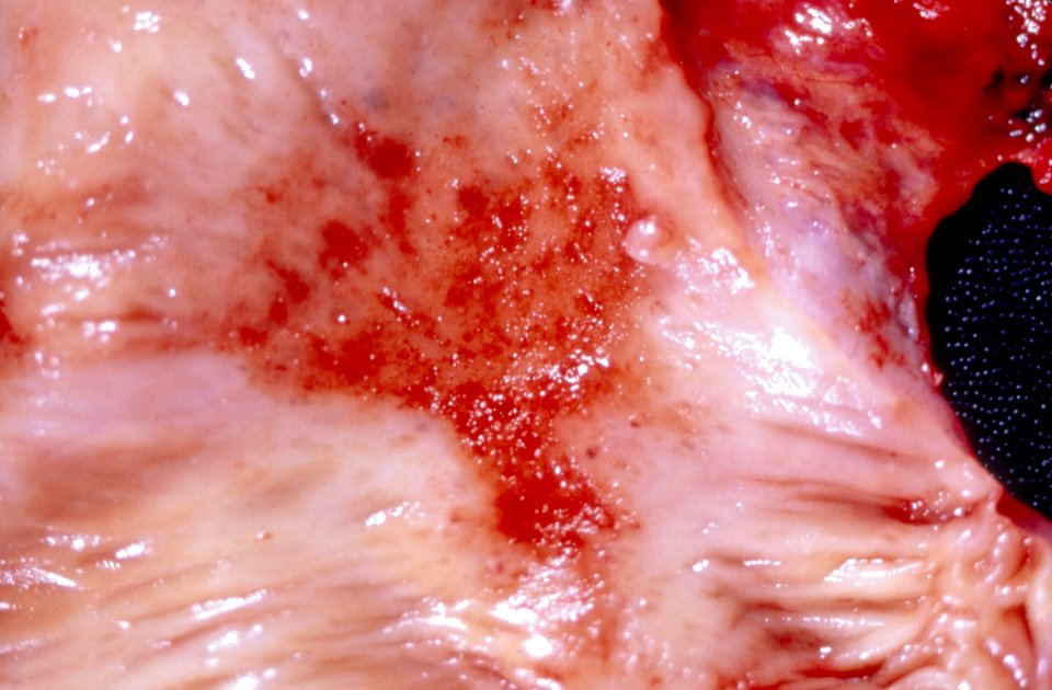 Diethylstilbestrol (des) cervix (14)