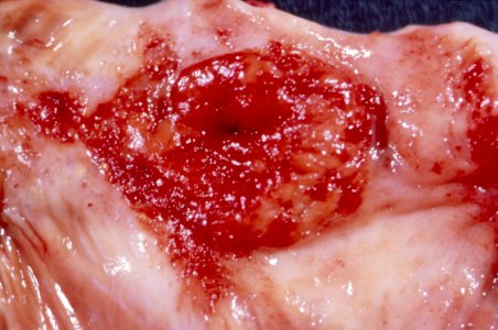 Diethylstilbestrol (des) cervix (46)