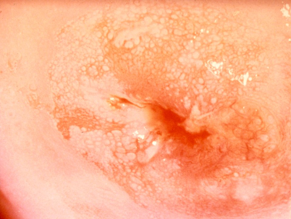 Diethylstilbestrol (des) cervix (18)