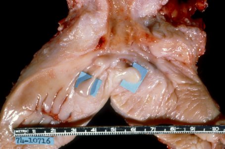 Diethylstilbestrol (des) cervix (12)