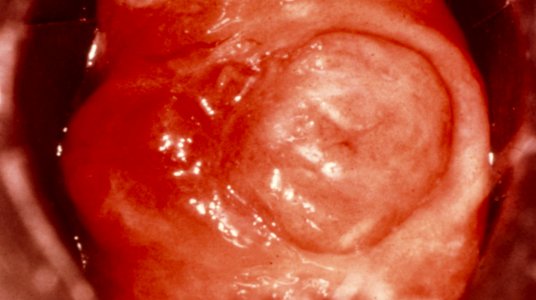 Diethylstilbestrol (des) cervix (5)