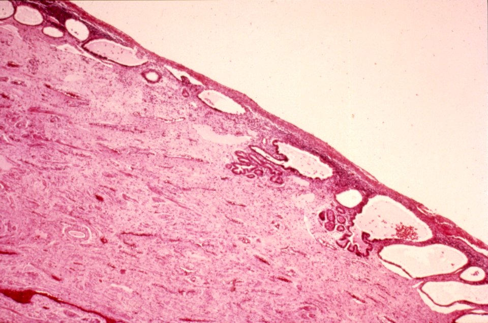 Diethylstilbestrol (des) cervix (25)
