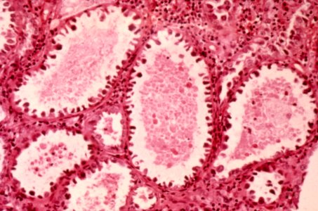 Diethylstilbestrol (des) cervix (53)