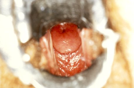 Diethylstilbestrol (des) cervix (2)