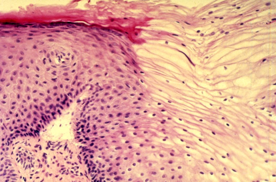 Diethylstilbestrol (des) cervix (29)