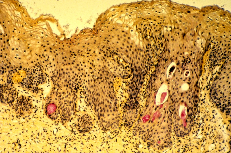 Diethylstilbestrol (des) cervix (23)