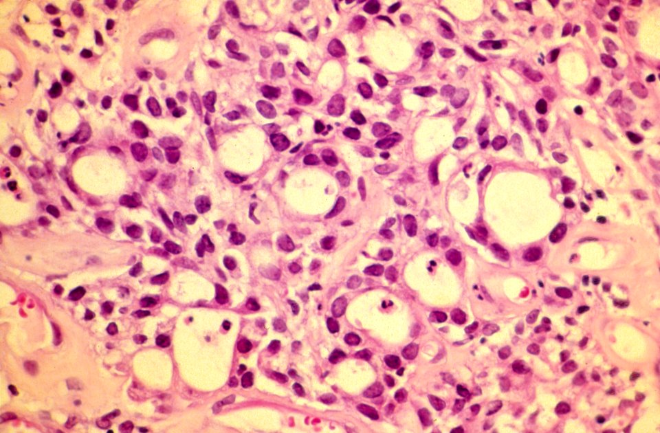 Diethylstilbestrol (des) cervix (60)