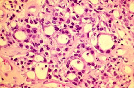 Diethylstilbestrol (des) cervix (60)