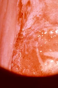 Diethylstilbestrol (des) cervix (32)