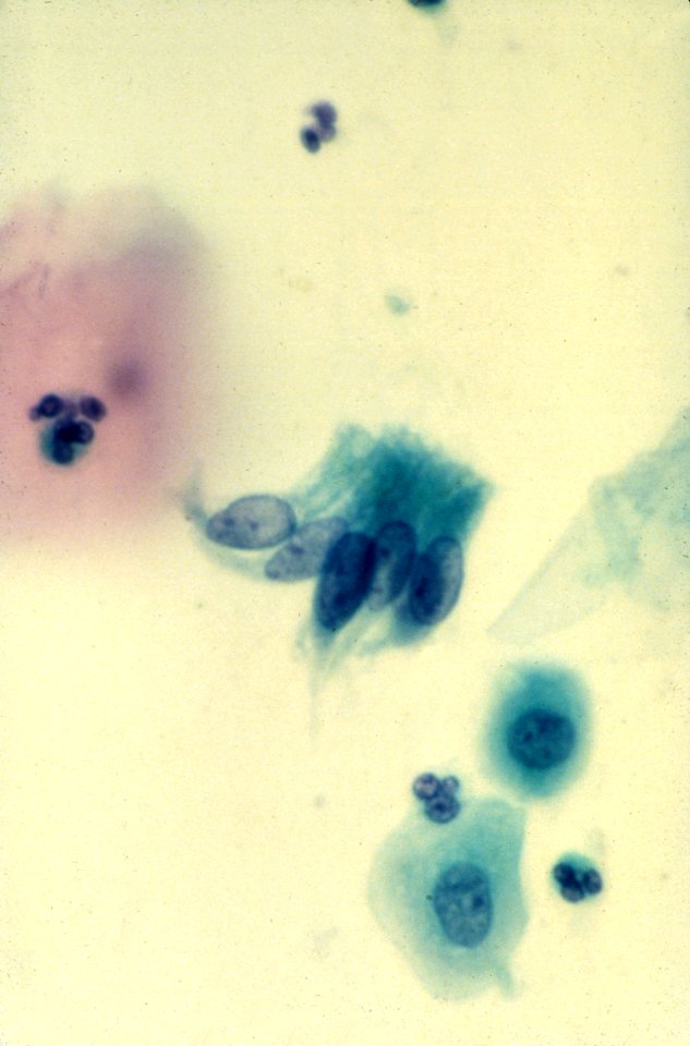 Diethylstilbestrol (des) cervix (36)
