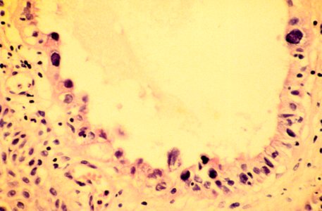 Diethylstilbestrol (des) cervix (64)