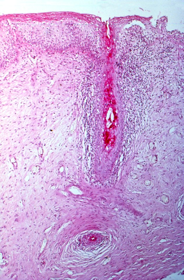 Diethylstilbestrol (des) cervix (30)