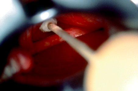Diethylstilbestrol (des) cervix (4)