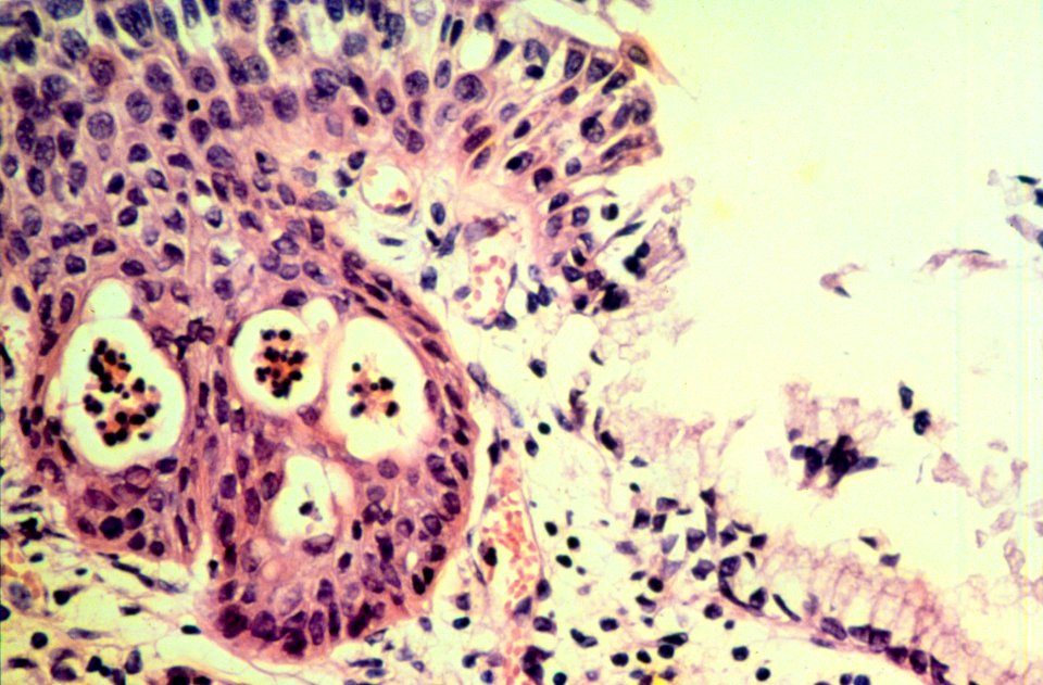 Diethylstilbestrol (des) cervix (68)